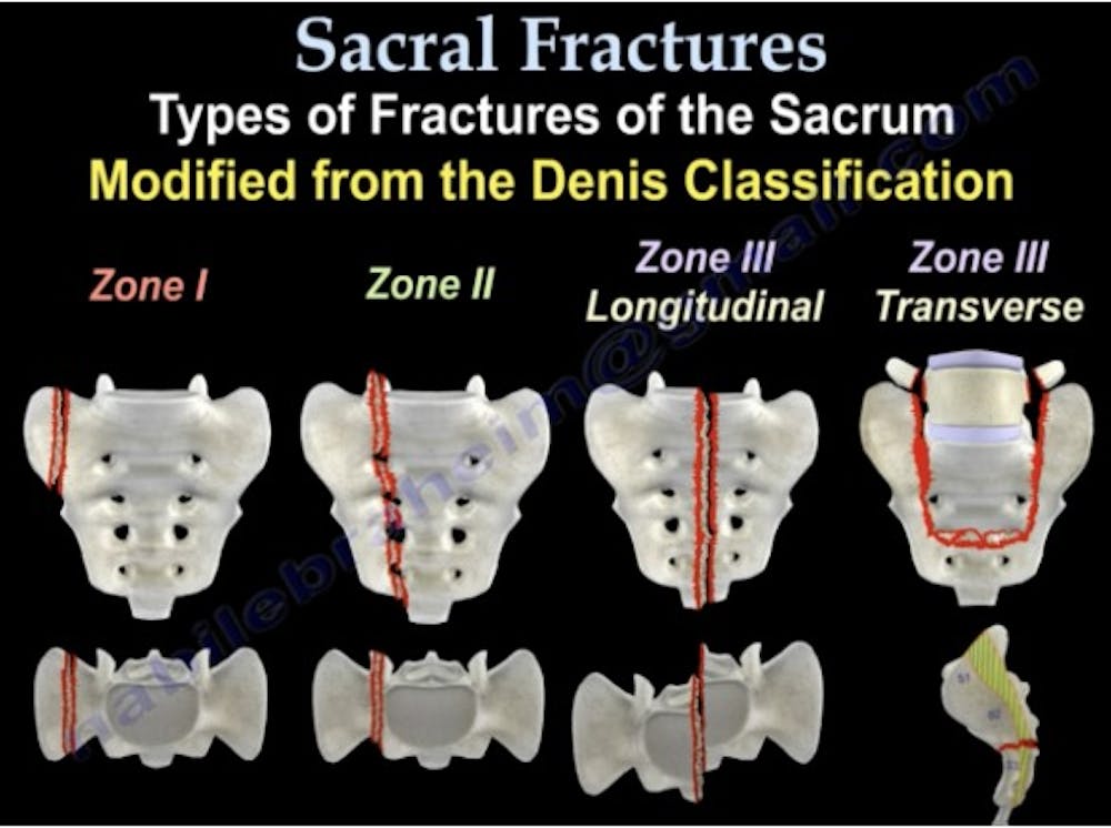 Κάταγμα καταπόνησης στη λεκάνη των δρομέων runbeat.gr